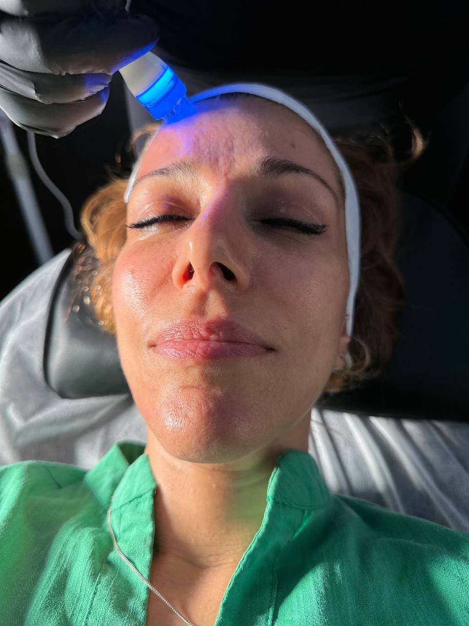 Microdermabrasion Treatment